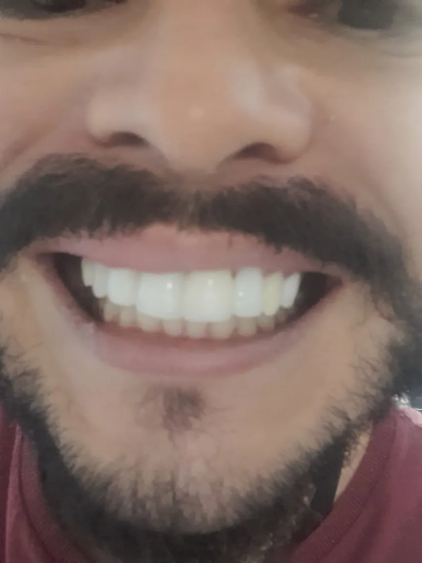 Sorriso de paciente depois de reabilitação estética